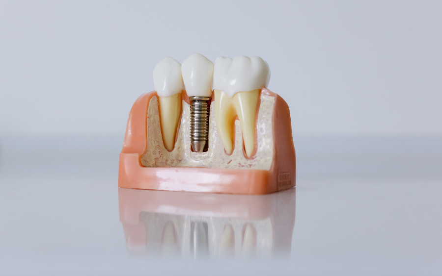 Dental Implants in St. Augustine, FL