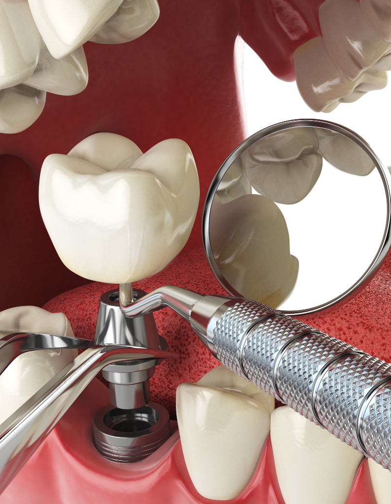 Dental Implants in St. Augustine, FL